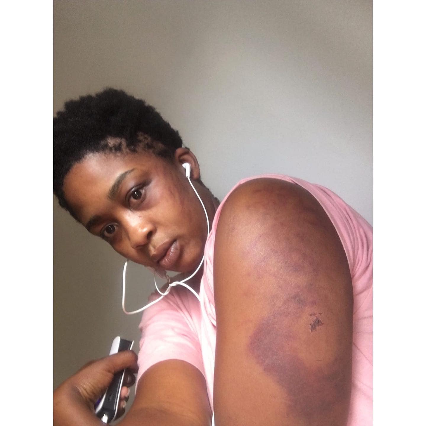 Trish Chinhau shows off her bruises following the assault