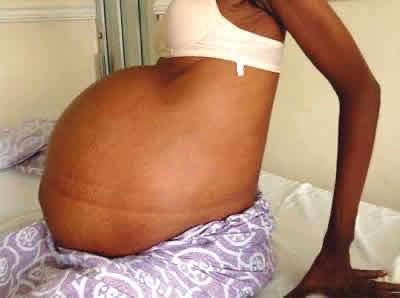 A 39-year-old woman is fortunate to still be alive after a 30-kilogramme tumour in her belly was surgically removed by medical professionals at Mpilo Central Hospital, 