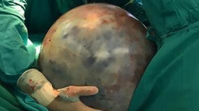 30KG tumour removed from woman's stomach at Mpilo Hospital
